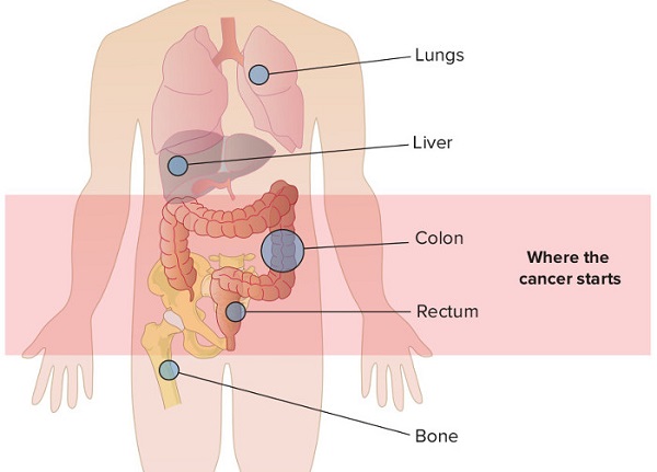 Ung thư di căn sống được bao lâu? Tổng hợp thông tin về ung thư cho bạn!